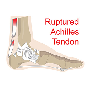 Achilles Tendon Rupture Clifton | Achilles Tendon Injuries Parsippany, NJ